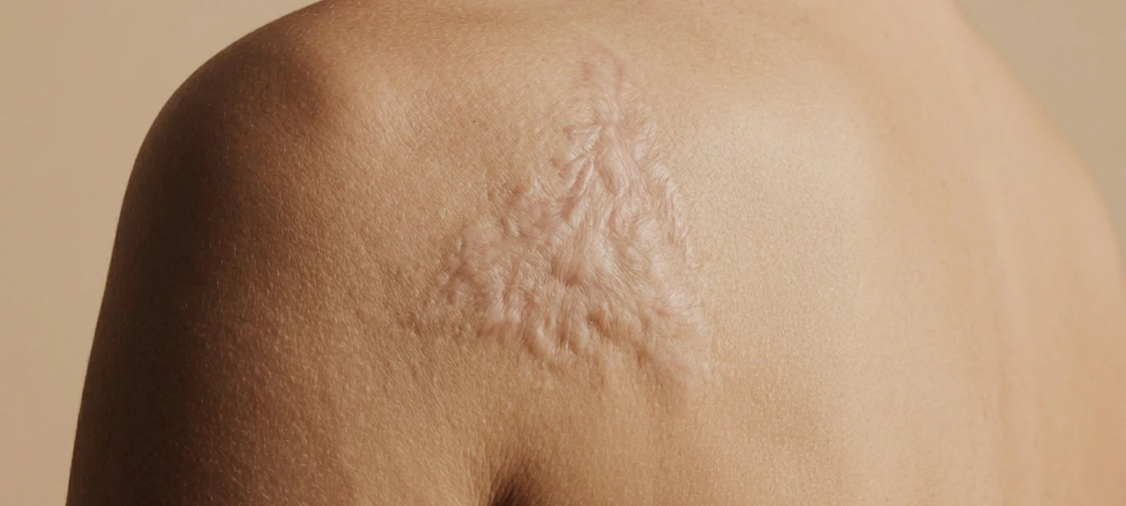 Burn care atmosphere image