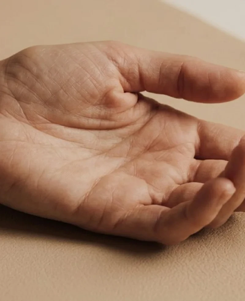 Close-up van een handpalm met een zichtbare streng of knobbel bij Dupuytren.