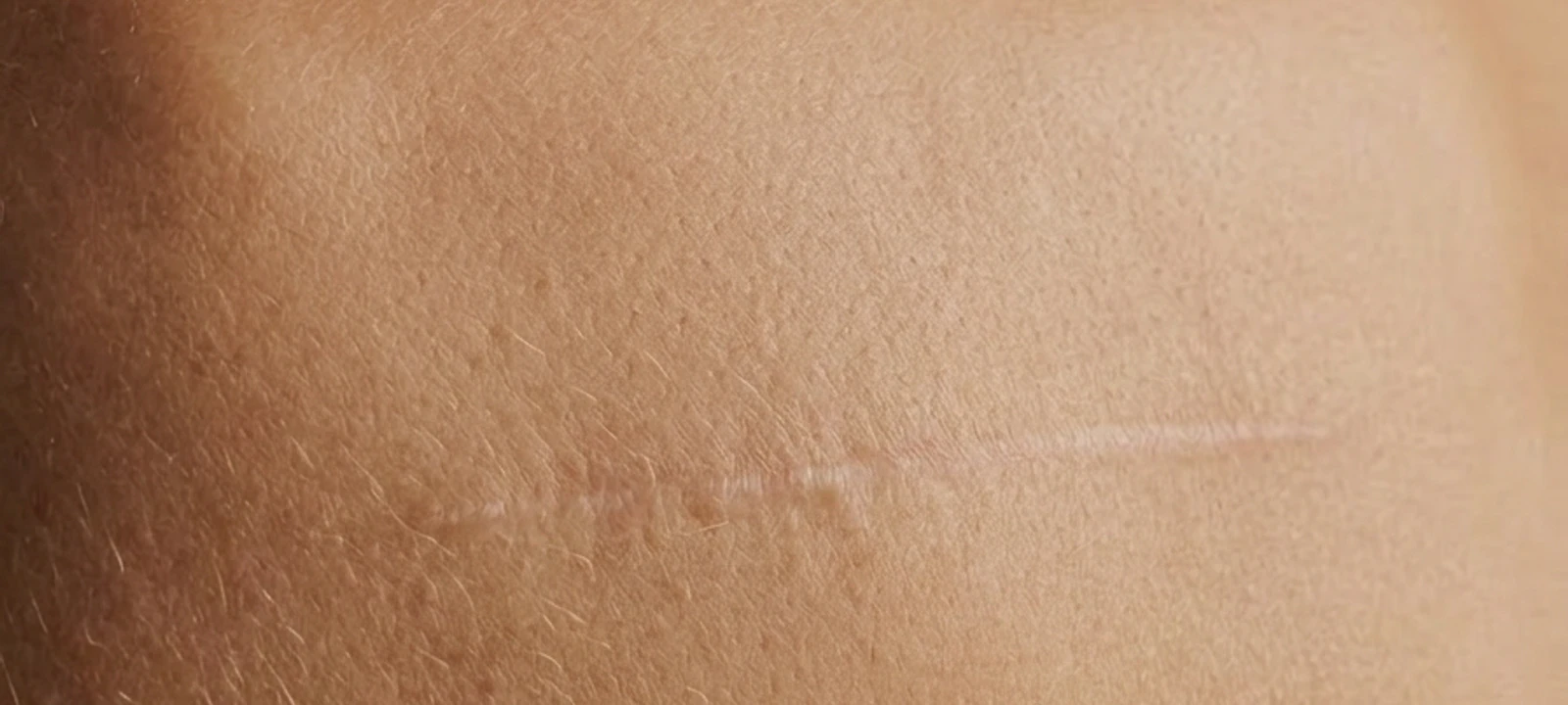 Scar correction atmosphere image